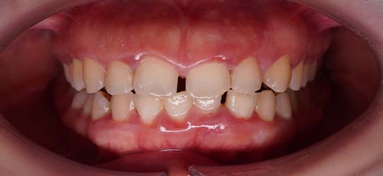 aft-bleaching-2-img