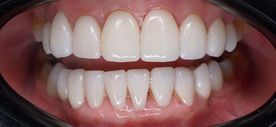 aft-veneers-3-img