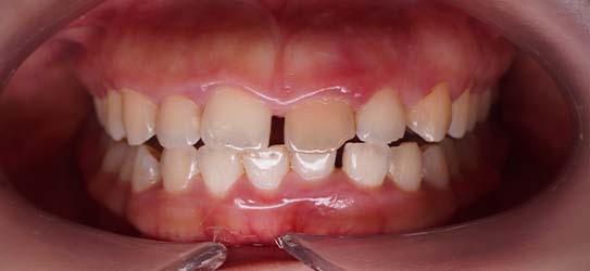 bef-bleaching-2-img