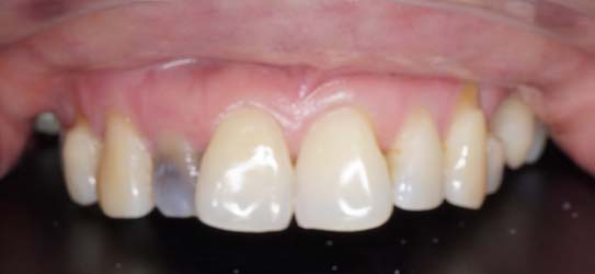 bef-bleaching-3-img